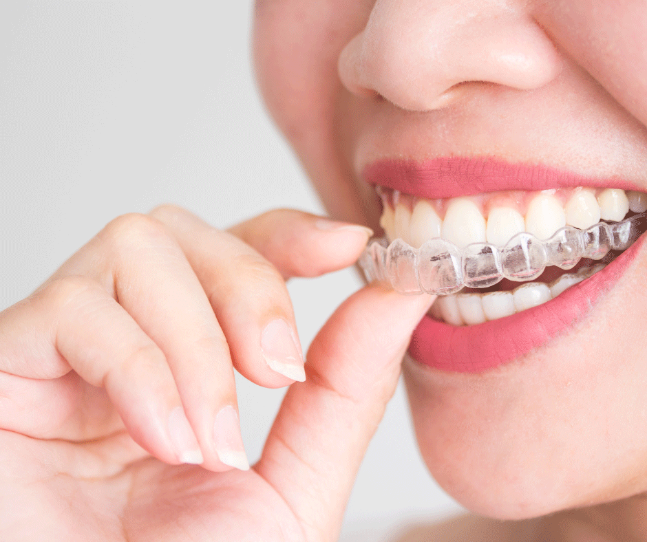 Invisalign London