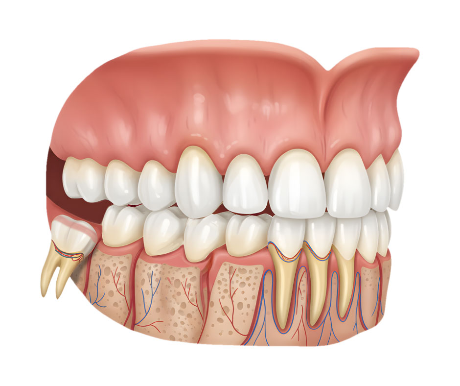 wisdom teeth removal