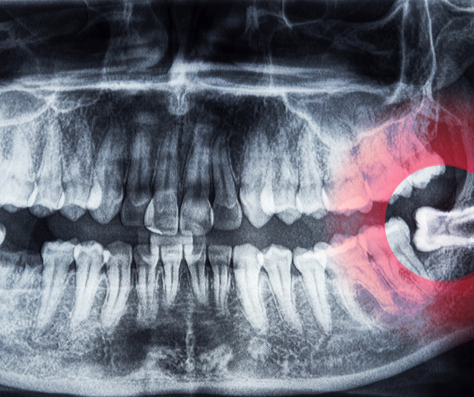 Wisdom Teeth Removal
