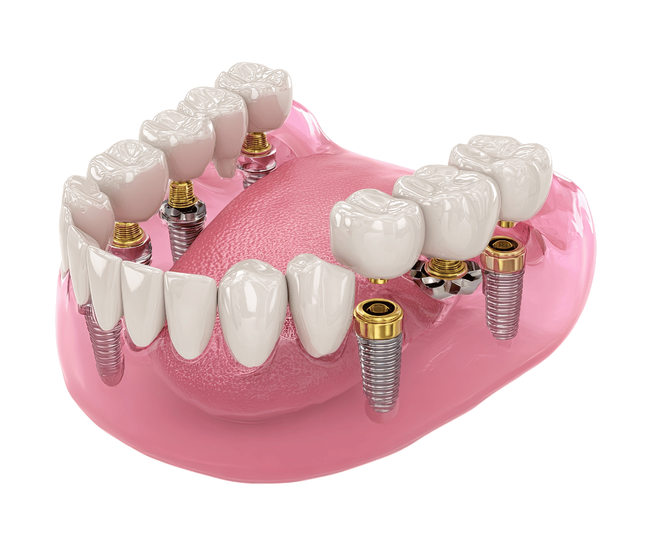 Full Implants Arch