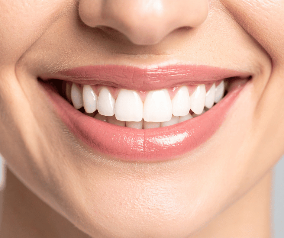 Teeth Whitening