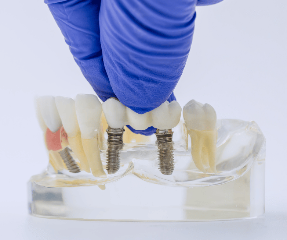 Dental Implants Supported Bridge