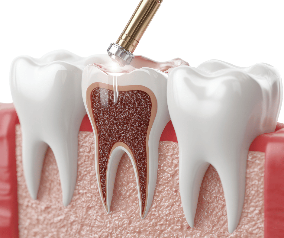 Root Canal Treatment in London